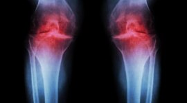 Studi 7 Tahun Mengungkapkan Artritis Reumatoid Dimulai Jauh Sebelum Gejala

