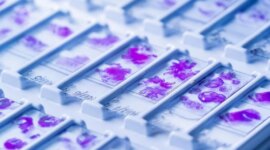 Apa yang Dipelajari AI dari Kanker Mengejutkan Para Peneliti

