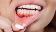 Masalah Gigi Umum Ini Dapat Mengancam Otak Anda

