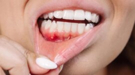 Masalah Gigi Umum Ini Dapat Mengancam Otak Anda

