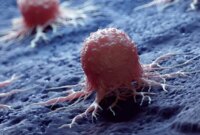 Nanodot Logam Kecil Menghilangkan Sel Kanker Sambil Menghemat Sebagian Besar Jaringan Sehat

