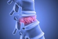 Sel Punca Lemak Menyembuhkan Patah Tulang Belakang dalam Studi Terobosan

