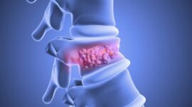 Sel Punca Lemak Menyembuhkan Patah Tulang Belakang dalam Studi Terobosan

