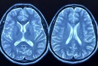 Studi Terbesar Jaringan Otak Afrika Amerika Mengungkap Gen Penting Alzheimer